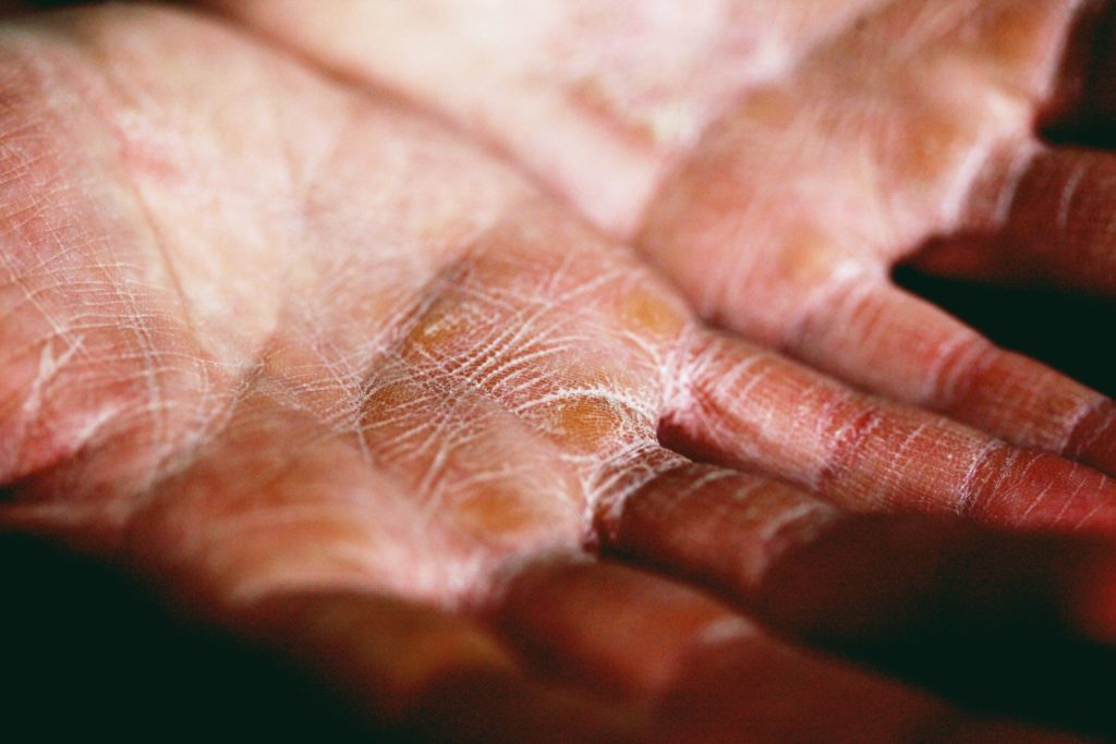 Good Skin Care Products - Image of very dry, cracked hands